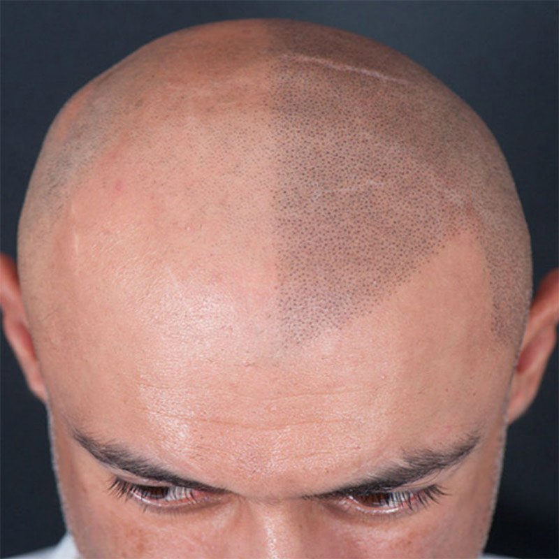 Hair Transplant Results