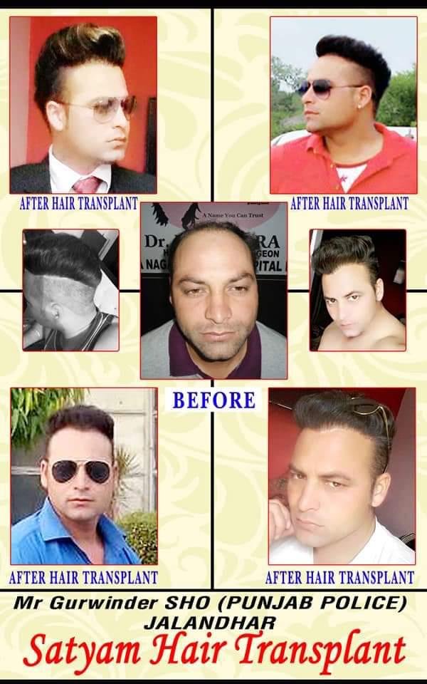 Hair Transplant Surgery