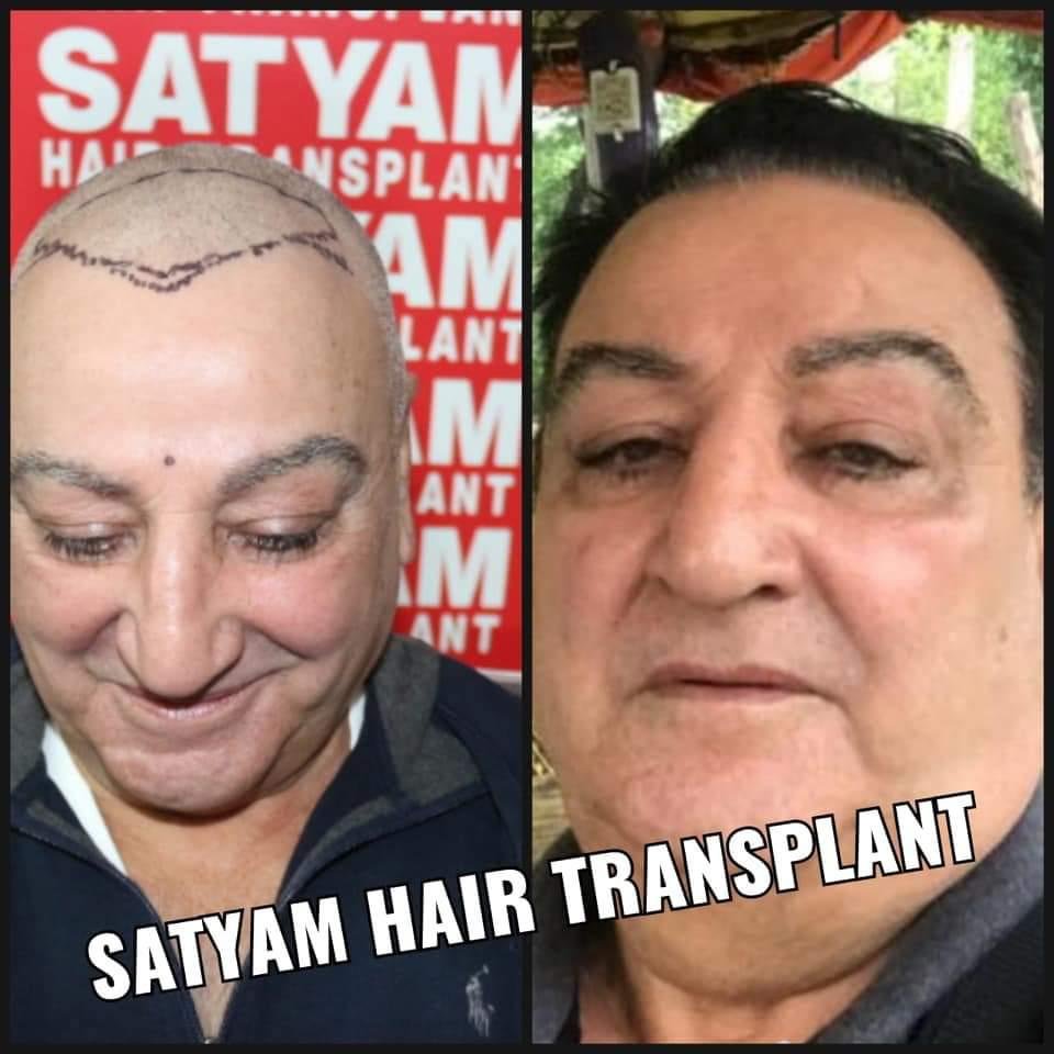Hair Transplant Before & After