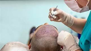 Hair Transplant Results